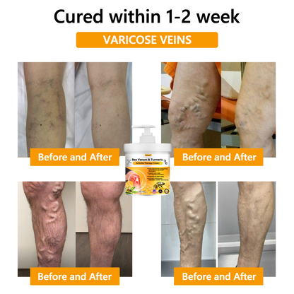 🔅🔅𝐎𝐲𝐢𝐤𝐞𝐲™ 𝐁𝐞𝐞 𝐕𝐞𝐧𝐨𝐦 & 𝐓𝐮𝐫𝐦𝐞𝐫𝐢𝐜 𝐀𝐫𝐭𝐡𝐫𝐢𝐭𝐢𝐬 𝐓𝐡𝐞𝐫𝐚𝐩𝐲 𝐂𝐫𝐞𝐚𝐦🐝 (𝐄𝐬𝐩𝐞𝐜𝐢𝐚𝐥𝐥𝐲 𝐬𝐮𝐢𝐭𝐚𝐛𝐥𝐞 𝐟𝐨𝐫 𝐬𝐞𝐧𝐢𝐨𝐫𝐬 &𝐀𝐀𝐎𝐒 𝐫𝐞𝐜𝐨𝐦𝐦𝐞𝐧𝐝𝐚𝐭𝐢𝐨𝐧𝐬)