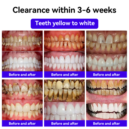 𝐅𝐀𝐓𝐎𝐍𝐆™ 𝐢𝐧𝐭𝐞𝐥𝐥𝐢𝐠𝐞𝐬𝐦𝐢𝐥𝐞 𝐁𝐞𝐞 𝐕𝐞𝐧𝐨𝐦 𝐓𝐫𝐞𝐚𝐭𝐦𝐞𝐧𝐭 𝐓𝐨𝐨𝐭𝐡𝐩𝐚𝐬𝐭𝐞🐼🐼（𝐒𝐮𝐢𝐭𝐚𝐛𝐥𝐞 𝐟𝐨𝐫 𝐚𝐥𝐥 𝐝𝐞𝐧𝐭𝐚𝐥 𝐚𝐧𝐝 𝐨𝐫𝐚𝐥 𝐩𝐫𝐨𝐛𝐥𝐞𝐦𝐬）